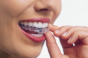 invisalign_1.jpg